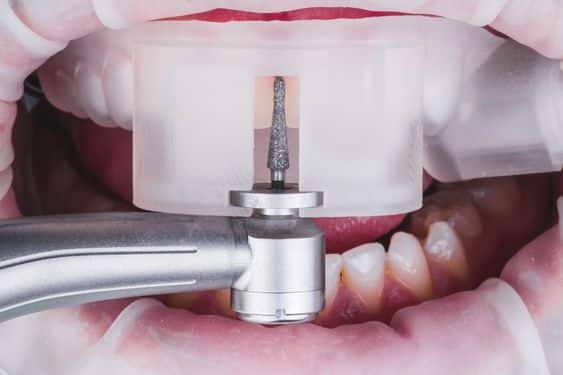 preparacion antes carillas inmediatas