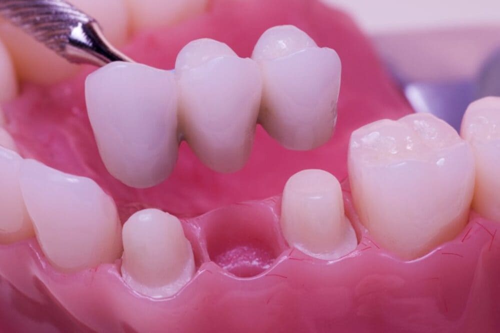 colocación de puentes dentales