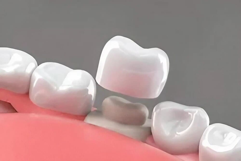 representación corona dental
