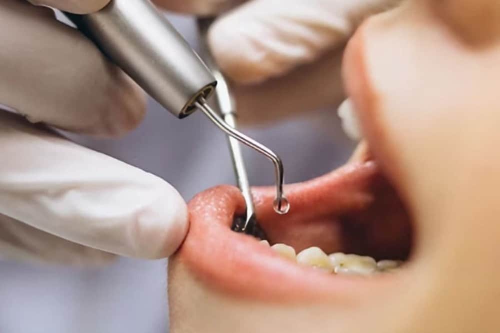 dentista usando utensilios dentales para tratamiento