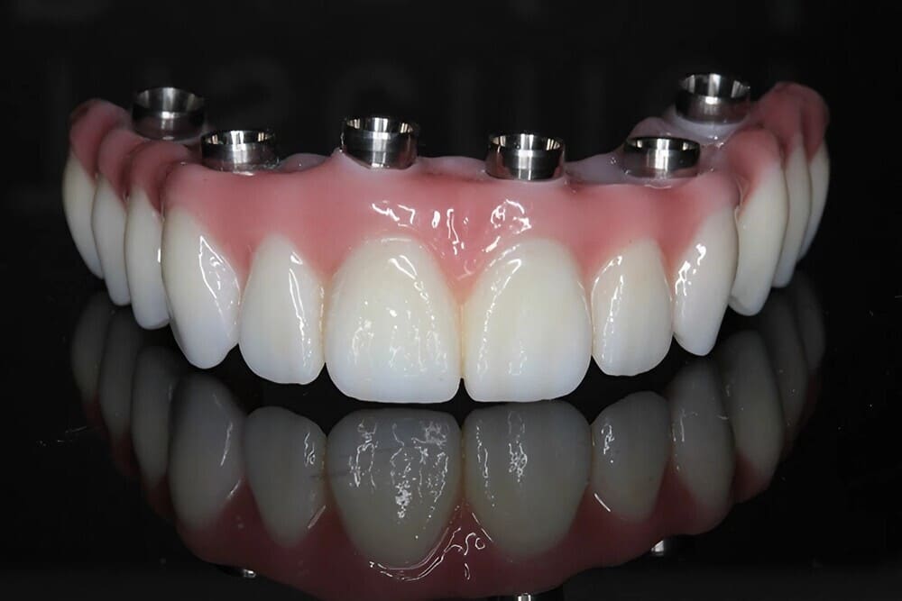 prótesis dentales sobre implantes