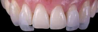 carillas sin tallado dental circonio