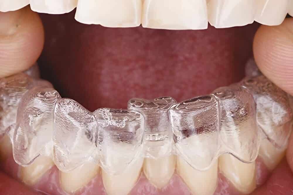 ortodoncia invisible con invisalign