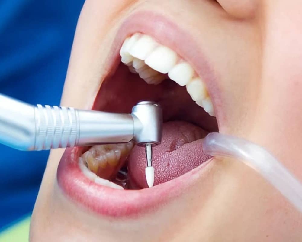 paciente mujer boca abierta realizándose tratamiento bucal