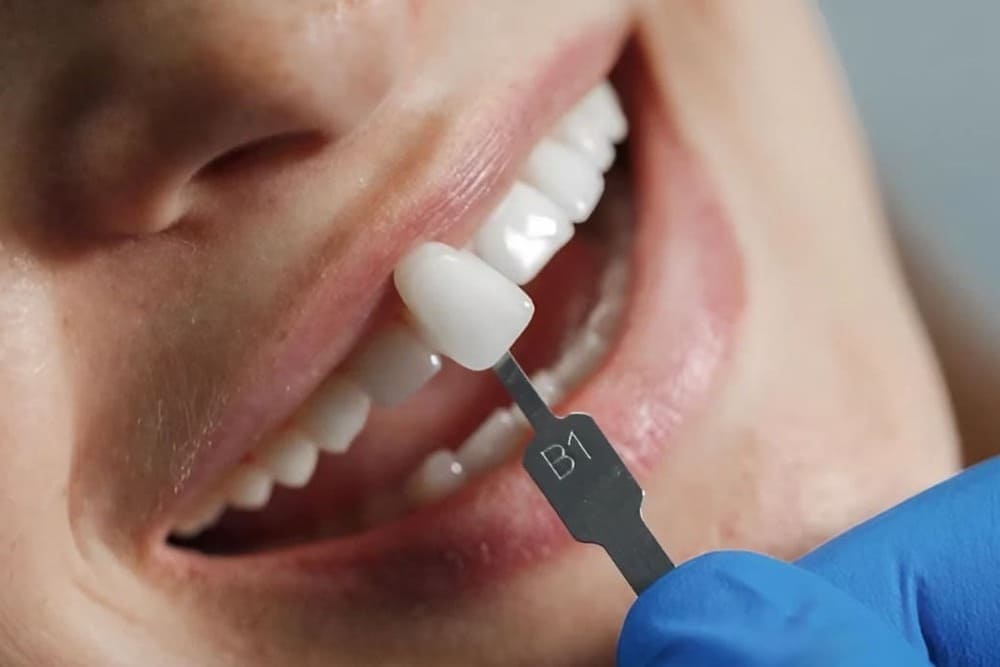 comparando blanco pieza dental con dentadura paciente