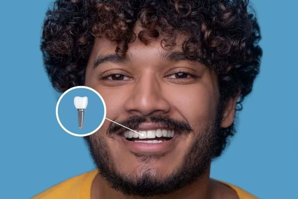 hombre con gran sonrisa mostrando implantes dentales