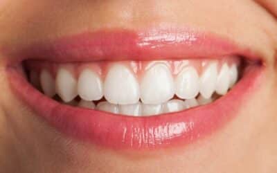Precio de las carillas dentales