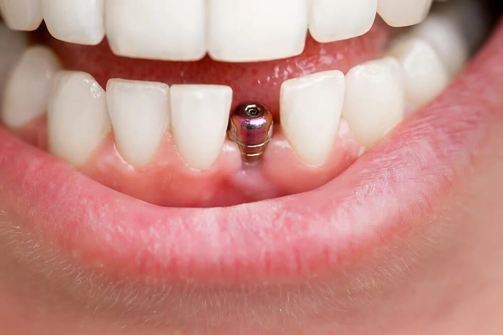 Implantes dentales y la importancia de la salud bucal integral