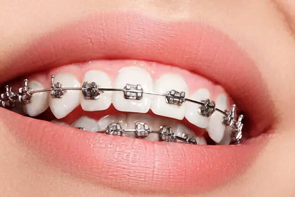 retratamiento de ortodoncia