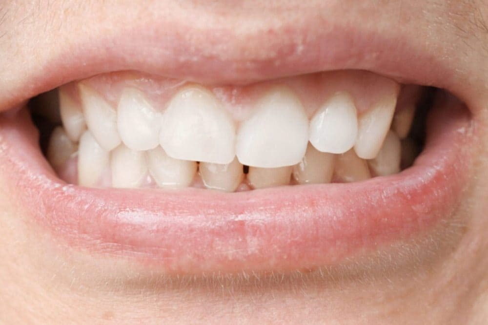 Corrigiendo problemas de mordida con ortodoncia: ¿Por qué es importante?