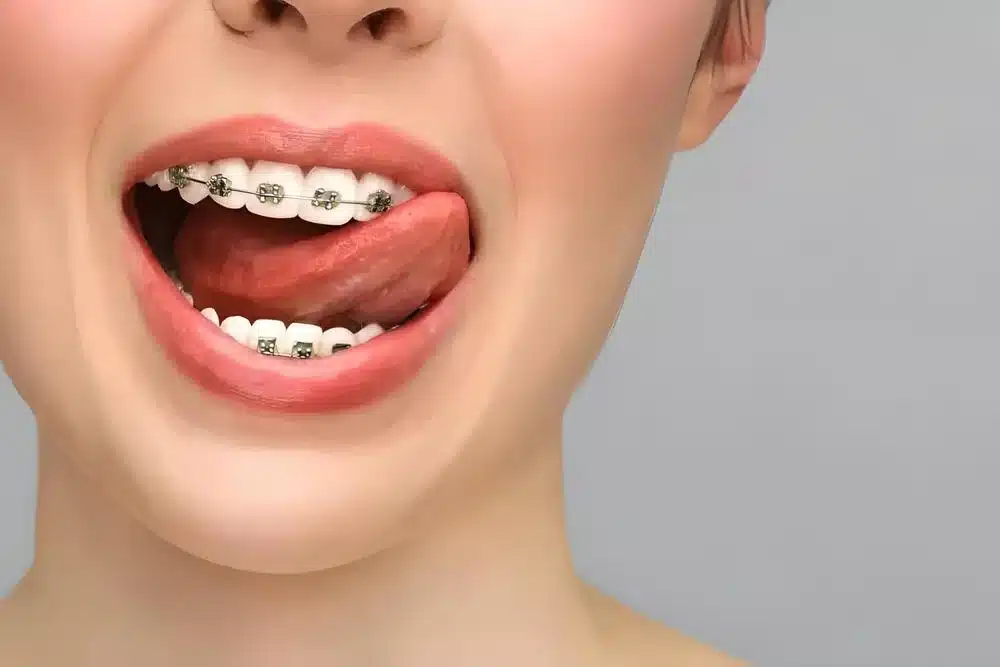 mujer mostrando sus brackets sacando lengua