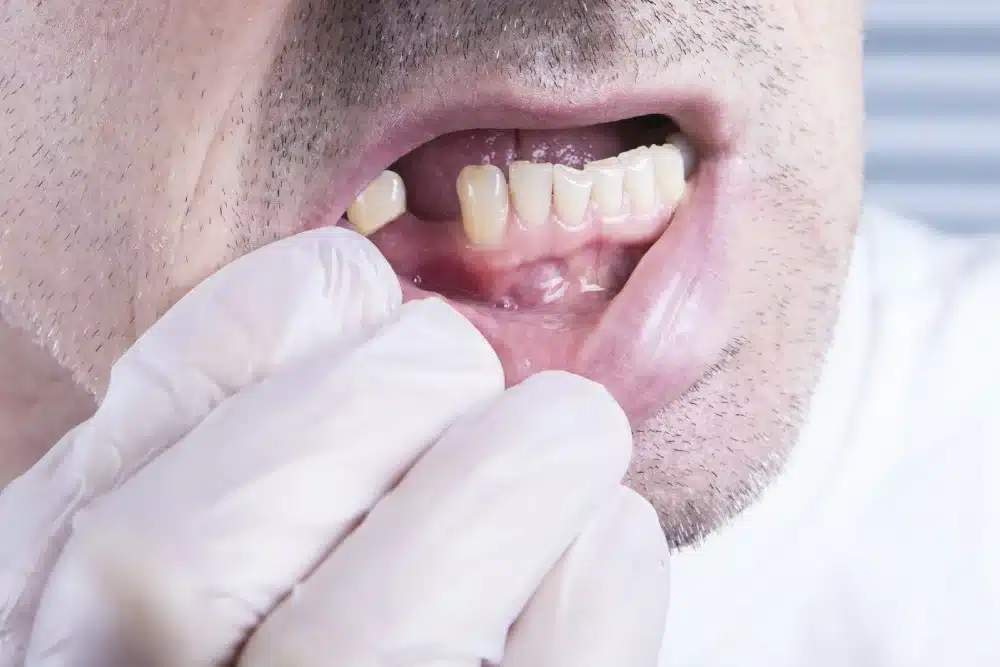 Pérdida de dientes: causas, consecuencias y tratamiento