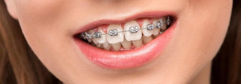 Niña sonriendo con brackets de ortodoncia infantil