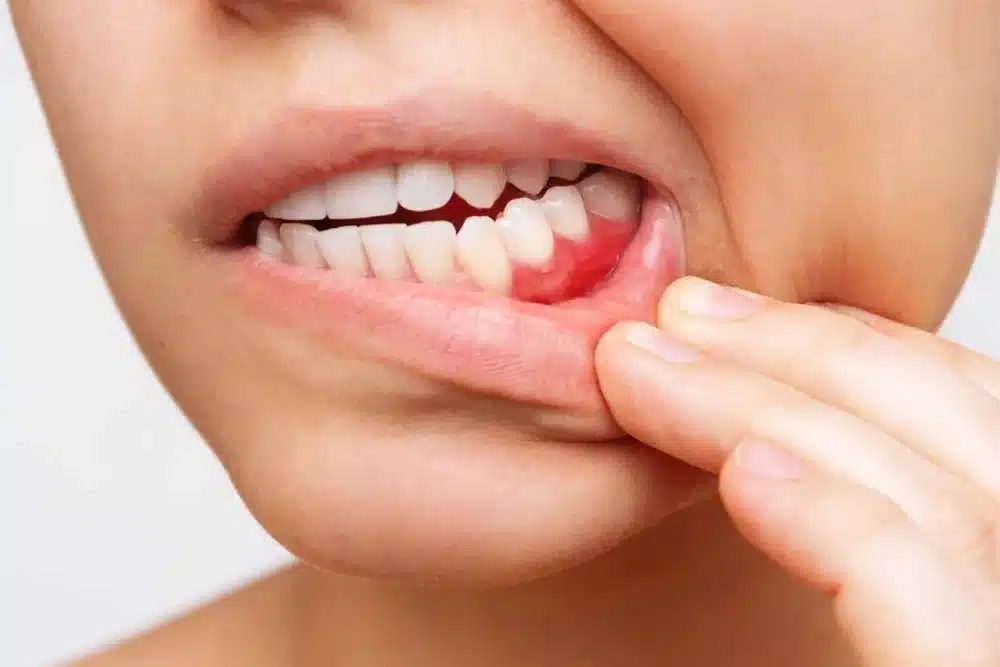 Periodontitis: Todo lo que necesitas saber