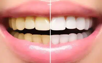 ¿Por qué se ponen los dientes amarillos?