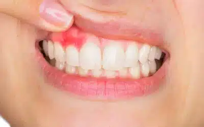 Gingivitis: Causas, síntomas y tratamiento