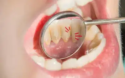 Placa dental: todo lo que debes saber