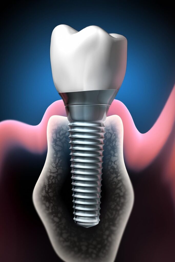 dibujo 3d de implante dental