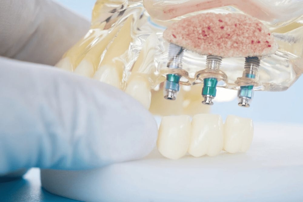 Implantes dentales tras una extracción: opciones y plazos
