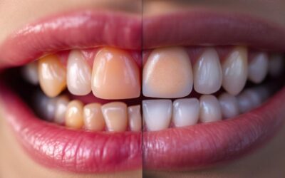 Leucoplasia: todo lo que debes saber