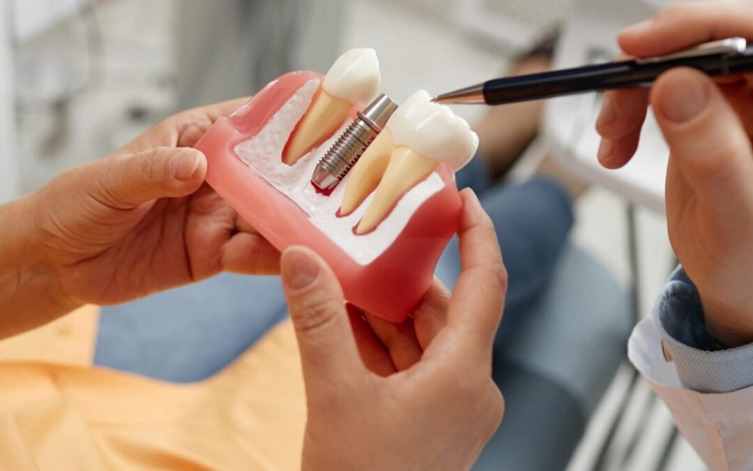 Ventajas de los implantes dentales guiados por ordenador
