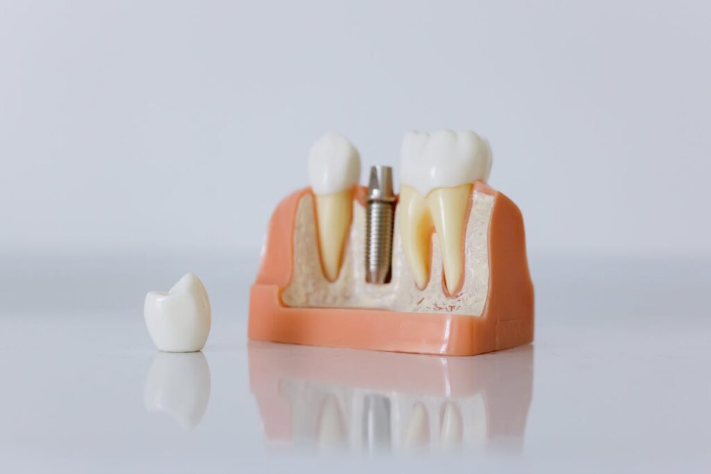 Implante dental